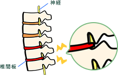 神経の圧迫を解消