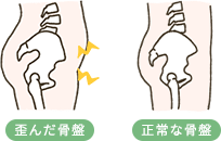 骨格の歪みの矯正