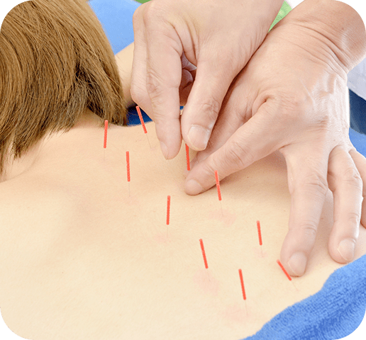 「鍼灸」とは？